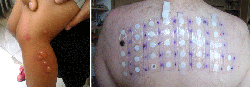 Auch die allergische Reaktion auf Giftefeu (links) kann mit dem Patch-Test (rechts) nachgewiesen werden.