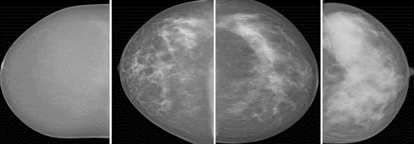 Mammogramme einer automatisierten, volumetrischen Brustdichtemessung, klassifiziert in die Dichtegrade 1, 2, 3 und 4 (von links nach rechts).