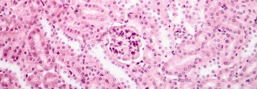 Autoantikörper gegen abweichend glykosylierte IgA-Moleküle führen zur Entzündung und Schädigung der Nierenkörperchen.