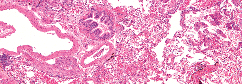 Bei der Lymphangioleiomyomatose kommt es zur unkontrollierte Proliferation glatter Muskelzellen.