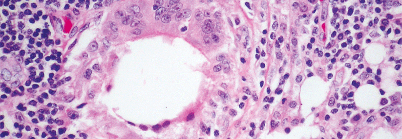 Fusionierte Makrophagen umzingeln bei einem Patienten mit Lipidpneumonie einen Fetttropfen.