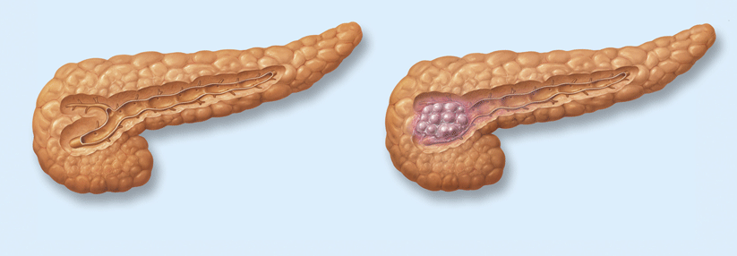 Chronische Pankreatitis macht anfällig für Diabetes und Tumorerkrankungen Wird die Entzündung der Bauchspeicheldrüse chronisch, steigt auch das Risiko für Pankreasmalignome.