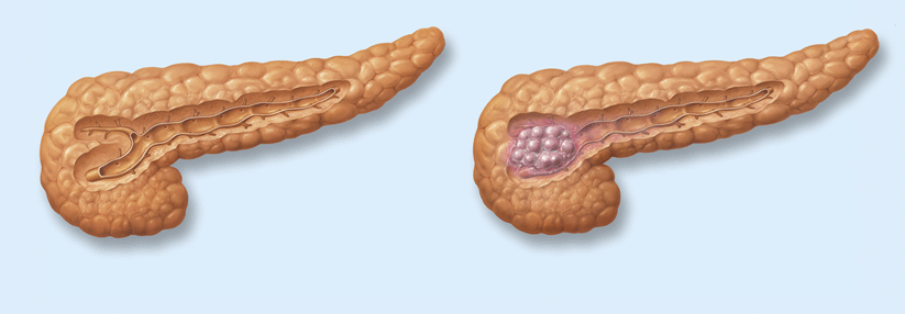 Wird die Entzündung der Bauchspeicheldrüse chronisch, steigt auch das Risiko für Pankreasmalig­nome.