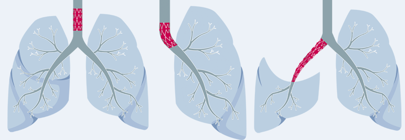 Die verschiedenen Transplantate unterstützen die Stabilisierung und die Regenerierung der betroffenen Lungenabschnitte.