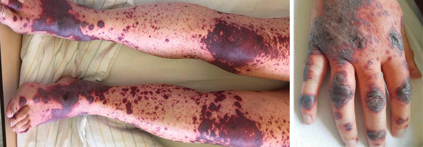 Nach einer Chlamydophila-pneumoniae-Infektion erkrankte der 68-Jährige an einer schweren Hautvaskulitis.