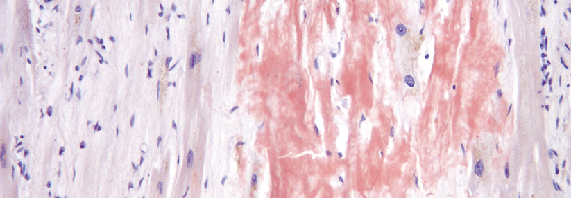 In der Kongorot-Färbung zeigt sich im Myokard rotes schaumig erscheinendes Material: Amyloid.