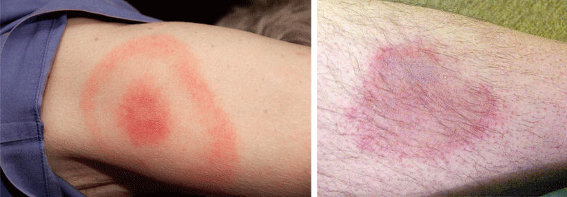 Bei Wanderröte genügen zehn Tage Doxycyclin Das Erythema migrans tritt in verschiedenen Erscheinungsformen auf.