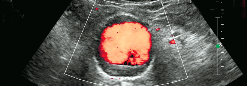 Leitlinie zum Aneurysma-Screening legt Kontrollintervalle fest Ist der Durchmesser des Bauchaortenaneurysmas kleiner als 5,5 cm, liegt das Rupturrisiko bei max. 1,61/100 Patientenjahre.