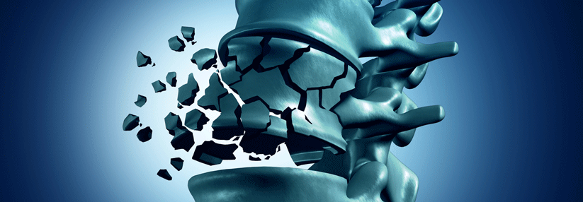 Osteoporose: Zur Langzeittherapie fehlen harte Fakten Die besten Daten zur Frakturhäufigkeit bei einer langfristigen Osteoporosebehandlung mit Bisphosphonaten stammen aus drei randomisierten Studien.