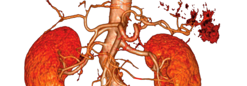 Die Lage eines Bauchaorten­aneurysmas wird im Verhältnis zu den Nierenarterien beschrieben. Hier befindet sich die Aussackung infrarenal.