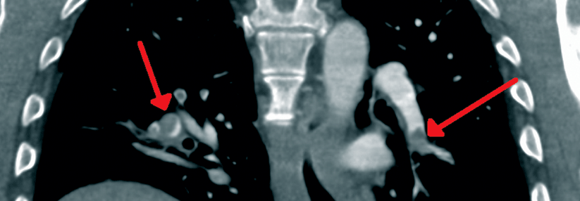 Bei hohem Risiko sollte gleich die Bildgebung erfolgen, in der Regel eine CT-Angiographie.
