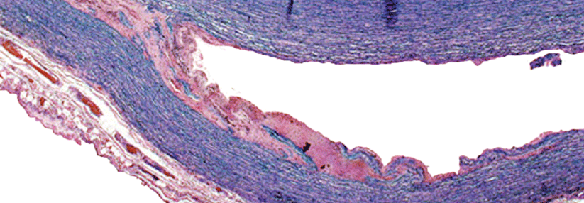 Eine Dissektion in der Aortenwand kann selten als Komplikation einer Riesenzell­arteriitis auftreten.