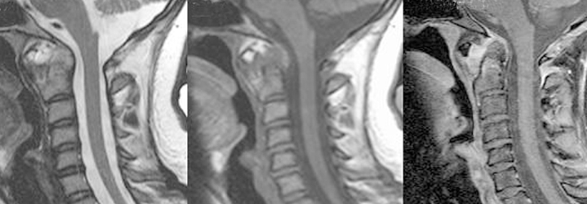 Erst mit den geeigneten MRT-Sequenzen wird das ganze Ausmaß bei der Patientin deutlich: Es zeigt sich eine floride Pannusbildung mit Osteitis an Dens axis und Corpus. Axis und Atlas weisen osteoproliferative Veränderungen auf. Es besteht eine atlantoaxiale Sub­luxation mit horizontaler Instabilität und Subluxation des Atlas nach links lateral/ventral.