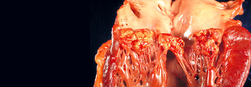 Rückhalt für restriktive Endokarditis-Prophylaxe Das Risiko, eine Endokarditis zu entwickeln, lag unter dem einer klassischen Hochrisikogruppe.