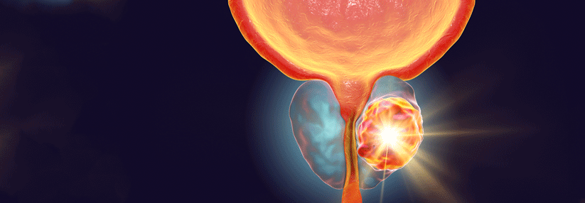 Die stereotaktische Bestrahlung wird mittlerweile auch beim Niedrigrisiko-Prostatakarzinom immer häufiger eingesetzt.