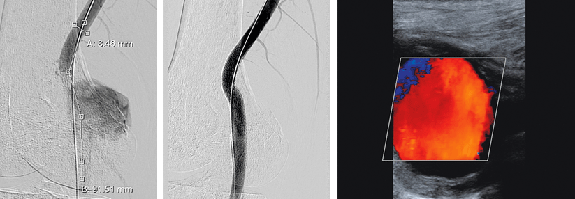 Arterielle Angiographie vor und nach der Implantation der Gefäßprothese (links). Im Sono misst das gedeckt rupturierte Poplitealarterienaneurysma 4,5 cm. Ein Gefäßverschluss ist nicht zu erkennen (rechts).