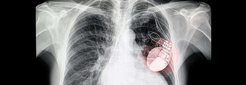 Neben dem Herzschrittmacher befand sich unbeabsichtigterweise noch ein Elektrodenrest im Körper des Patienten. (Agenturfoto)