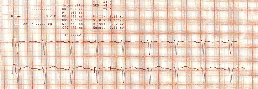 Auch Übelkeit und Erbrechen durch die Chemotherapie können via Elektrolytstörung die QT-Zeit verlängern.