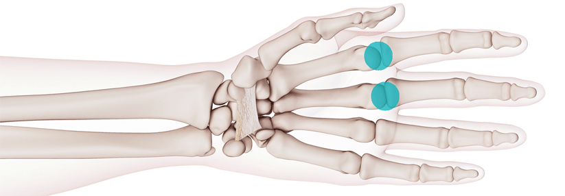 Klassischerweise sind die Metacarpophalangealgelenke 2 und 3 beider Hände betroffen.