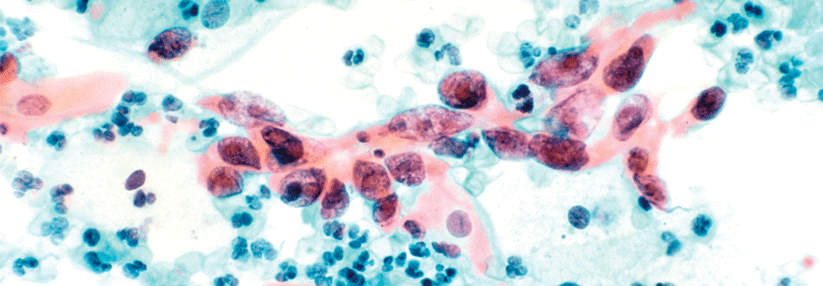 Das Zervixkarzinom ist die vierthäufigste Krebserkrankung bei Frauen. Mittels PAP-Test werden die Tumorzellen sichtbar.