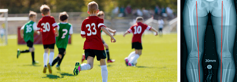 Kniefehlstellung wird durch Fußballtraining in der Jugend gefördert Wenn Kinder zu intensiv Fußball spielen, müssen sie aufpassen, dass sie nicht getunnelt werden.