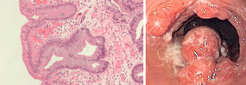 Mit der Kombination aus Esomeprazol und ASS verlängert sich nicht nur die Lebenszeit von Barrett-Ösophagus-Patienten (links), sondern wird auch die Speiseröhre vor möglichen Karzinomen (rechts) geschützt.