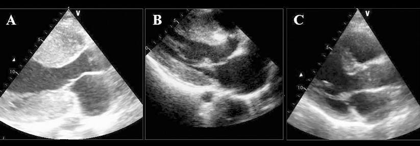 Die Echokardiographie von drei Geschwistern mit HOCM zeigt die deutliche Variabilität der Hypertrophie in Diastole.