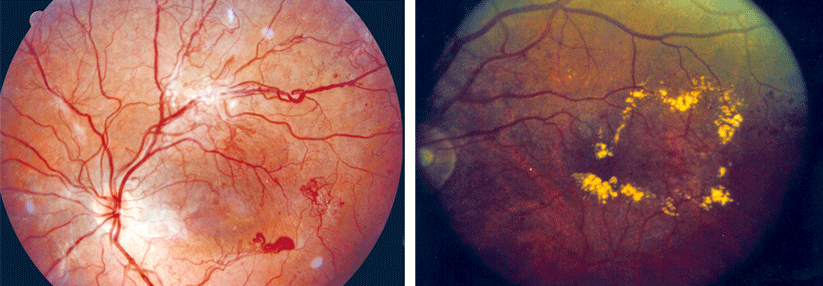 Bei der proliferativen Retinopathie (links) können krankhafte, neue Blutgefäße in den Glaskörper wachsen. Ein diabetisches Makula­ödem (rechts) droht bei jeder Form der Retinopathie.