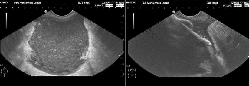 Punktion der infizierten Nekrose und Implantation des Metallstents erfolgen unter endosonographischer Kontrolle.