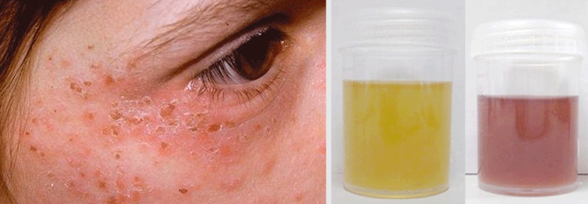Porphyrin-Zwischenprodukte bilden unter UV-Licht Sauerstoffradikale. Akkumulieren sie in der Haut, werden exponierte Stellen stark geschädigt (links). Manchmal zeigen sich Porphyrien auch durch eine Rotfärbung des Urins (rechts).