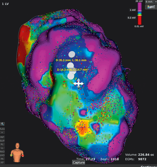 Mapping auf hochauflösendem Niveau: Mehr als 10 000 Datenpunkte lieferten ein Bild des linken Ventrikels.