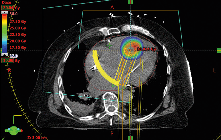 So ließ sich das arrhythmogene Areal genau identifizieren und das Zielvolumen für die Bestrahlung berechnen.