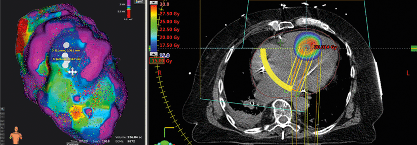 Mapping auf hochauflösendem Niveau (links): Mehr als 10 000 Datenpunkte lieferten ein Bild des linken Ventrikels. So ließ sich das arrhythmogene Areal genau identifizieren und das Zielvolumen für die Bestrahlung berechnen (rechts).