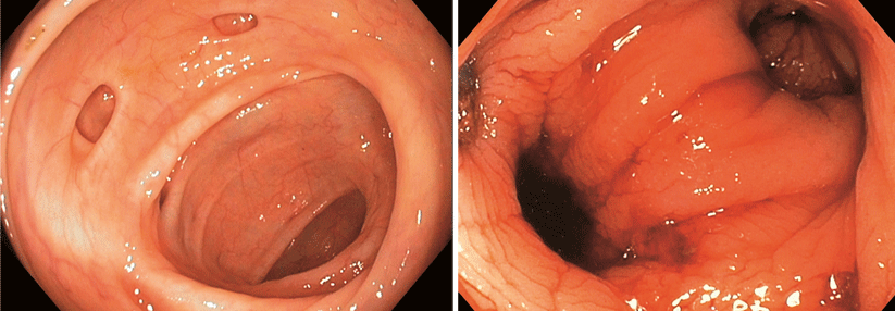 Werden ältere Herrschaften gespiegelt, kommt es schon mal vor, dass der Gastroenterologe von Divertikeln angelacht wird (Links). Beginnen die Aussackungen in der Dickdarmwand zu bluten, muss dies in der Regel stationär abgeklärt werden (Rechts). Wichtig ist die Volumenersatztherapie.