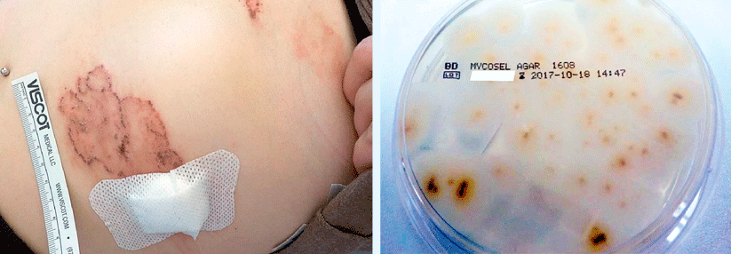 Hautbefund bei stationärer Aufnahme (links). Im Labor bestätigte sich eine Infektion mit Trichophyton erinacei (rechts).