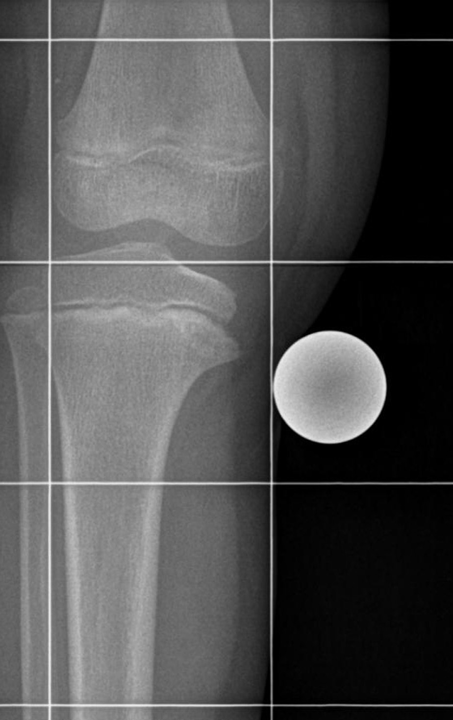 Der Morbus Blount, eine Wachstumsstörung der medialen Tibia-Epiphysenfuge, betrifft vor allem afrikanischstämmige Kinder.