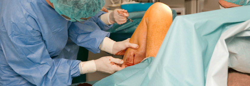 Krampfadern wer­den meist operativ behandelt. Der Eingriff sollte sich immer auf erkrankte Abschnitte beschränken.
