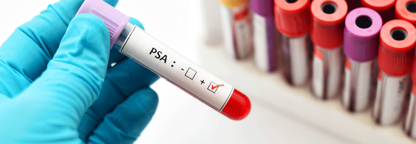 Der PSA-Test kann durch viele Faktoren beeinflusst werden und zu Überdiagnosen führen. Achtung ist daher geboten!
