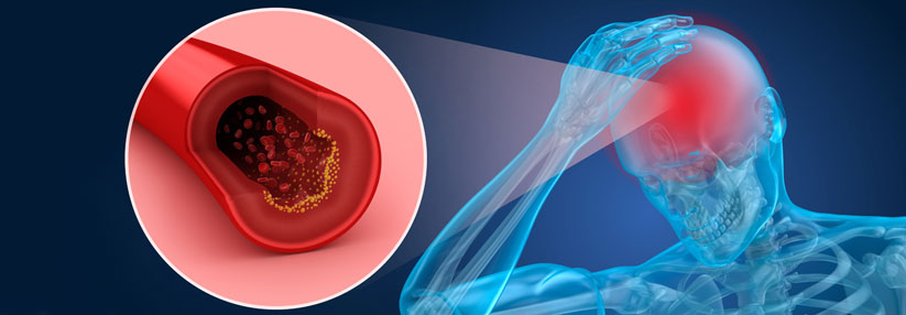 Die Hämorrhagie-Wahrscheinlichkeit nimmt unter der Kombitherapie mit ASS und Clopidogrel deutlich zu.