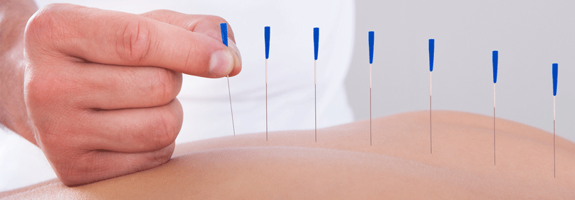 Die Akupunktur kann bei einer stabilen Angina Pectoris die Symtomlast senken.