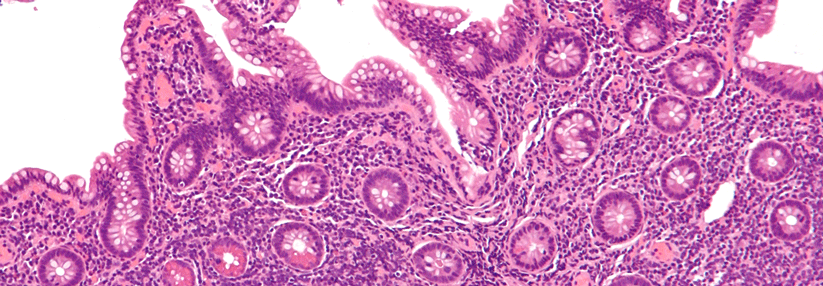 Am häufigsten starben Patienten an einer Progression ihrer Lymphom-Erkrankung.