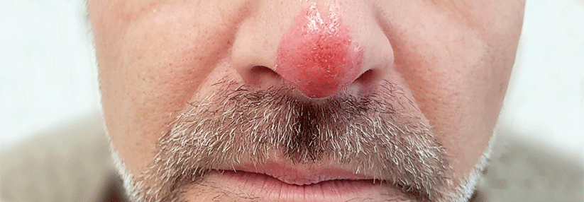 Ein scharf begrenztes Erythem an der Nasenspitze: Am Anfang der Behandlung stand die Verdachtsdiagnose Erysipel.