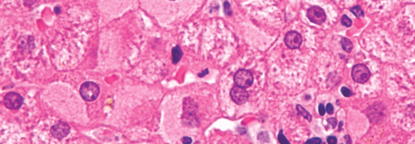 Typisch für die chronische Infektion sind sogenannte „Mattscheiben“-Hepatozyten mit trübem Zytoplasma.
