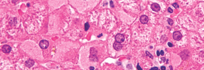 Funktionelle Heilung der chronischen Hepatitis B rückt näher Typisch für die chronische Infektion sind sogenannte „Mattscheiben“-Hepatozyten mit trübem Zytoplasma.