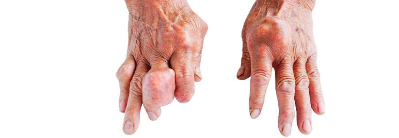 Uratablagerungen in der Hand sind typisch für eine tophöse Gicht.