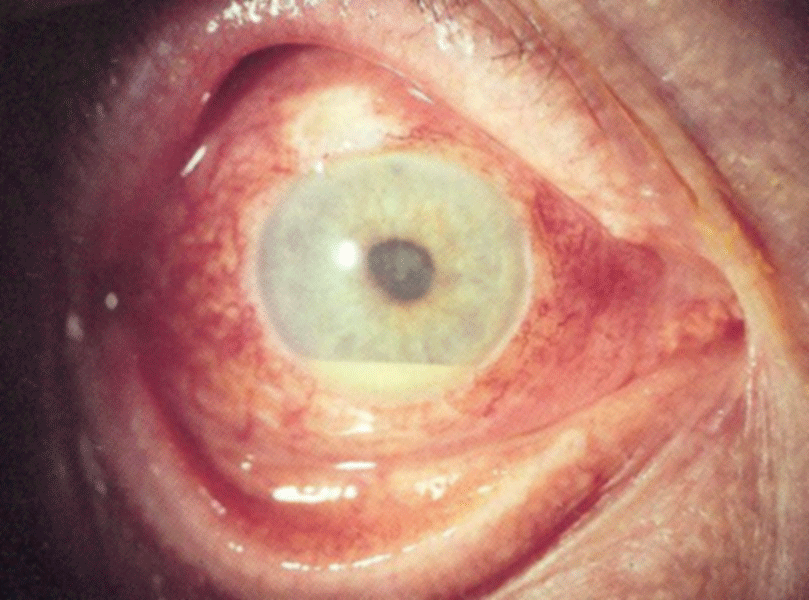 Hypopyon bei einer Uveitis
