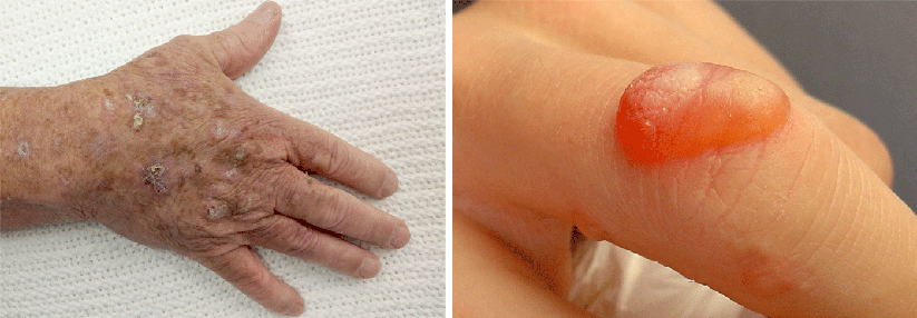 Nach der Kryotherapie (rechts) einer aktinischen Keratose (links) mit flüssigem Stickstoff bilden sich schmerzhafte Blasen. 