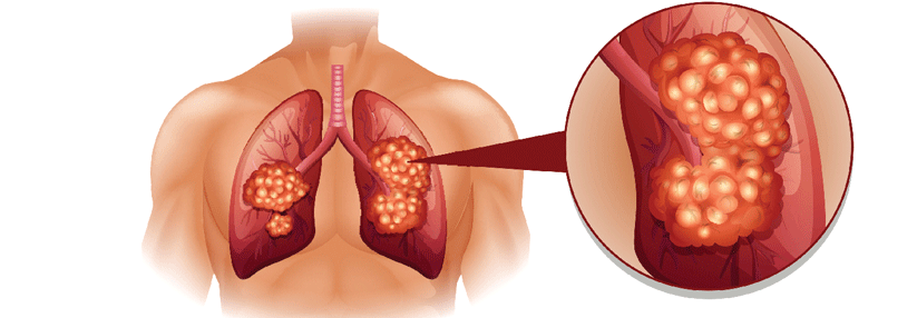 Die Immuntherapie schlägt beim Lungenkrebs Wurzeln.