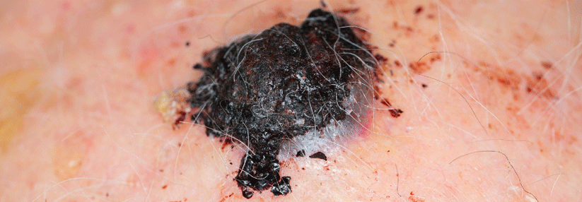 Patienten mit schwarzem Hautkrebs wurden mit der Kombination oder mit einem der Hemmer allein behandelt.