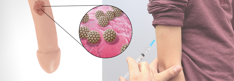 hpv impfung jungen bis wann detection of human papillomavirus type 16 integration